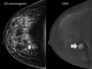 Contrast Enhanced Mammogram